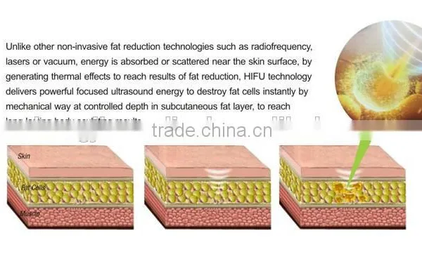 New Tech! Liposonix HIFU for Face Body Slimming Machine/liposunic Ultrasound Machine/reduce Cellulite photo-3