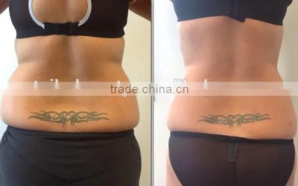 Distributor Wanted Cryolipolysis Fat Freeze Loss Weight Slimming Equipment/fat Freeze Belt/slim Freezer Weight Loss Machine photo-6