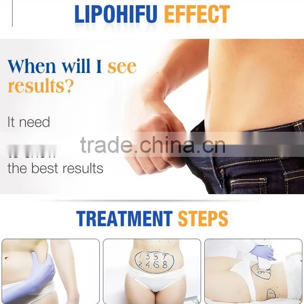 Gold Search Machine Ultrashape HIFU Painless Fat Local Fat Removal Removal Slimming Machine -01 Forehead Wrinkle Removal 50 / 60Hz photo-4