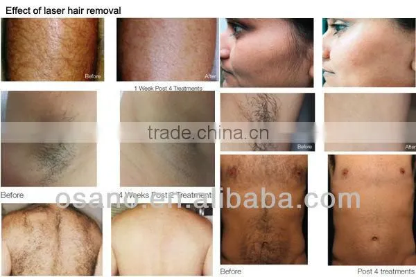 Bode 2016 808nm Diode Skin Rejuvenation Laser Hair Removal Machine photo-6