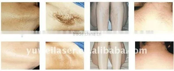 New Products Bikini Line Hair Removal Machine 808nm Diode Laser Hair Removal photo-6