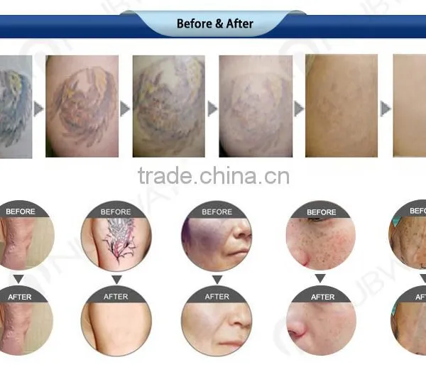 2016 Varicose Veins Laser Treatment Pigments Tattoo Removal nd Yag Laser Machine Prices photo-5