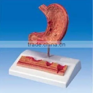 Stomach Model Gastric Disease Model