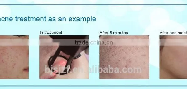No Pain F5 Hot Sell Co2 Fractional Laser Tattoo /lip Wrinkle Removal Line Removal Used Beauty Salon Equipment For Sale 10600nm photo-6