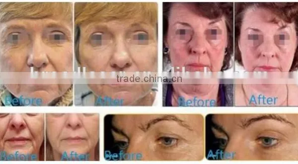 High Frequency Machine For Acne 2016 Hot Sale Hifu Face And Neck Lifting Machine Pain Free photo-6