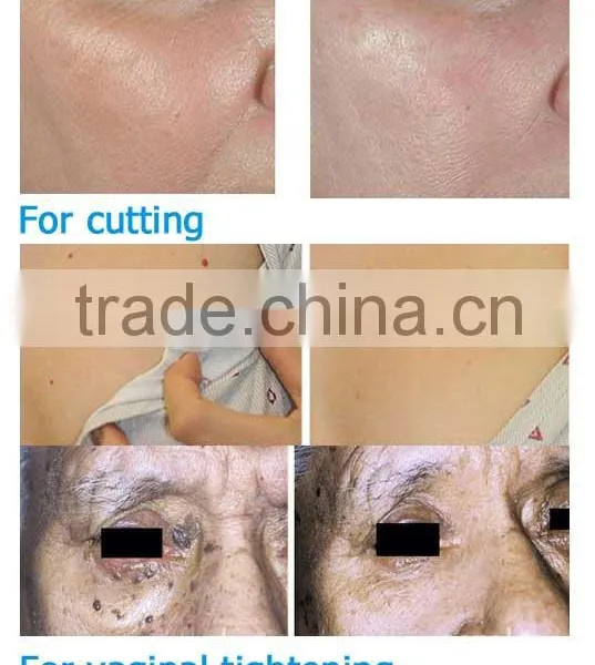 High Frequency  High Quality Hifu Vaginal Tightening Machine 0.2-3.0J photo-4