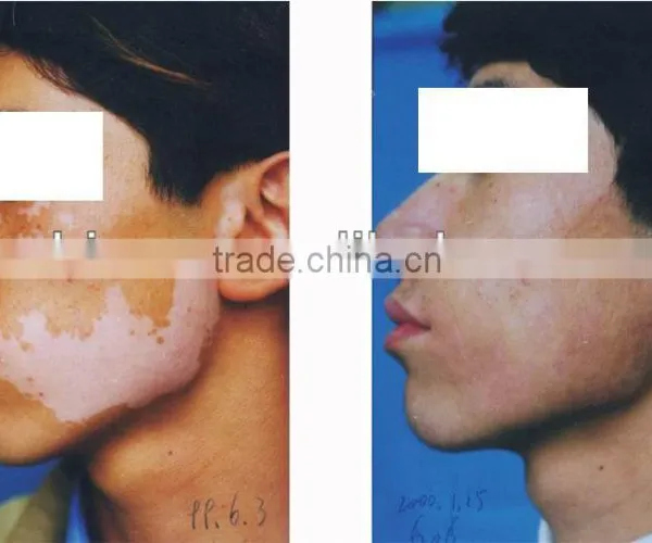 Epidermis Transplantation Vitiligo Machine photo-3