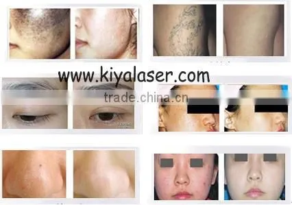 Portable Q Switched nd Yag Laser Tattoo Removal / Q-switch Laser for Tattoos Removal photo-6