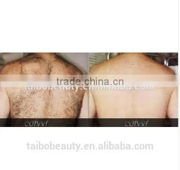 Super German Bars 808 Diode Painless Permanent All Color Hair Removal Laser Machine photo-6