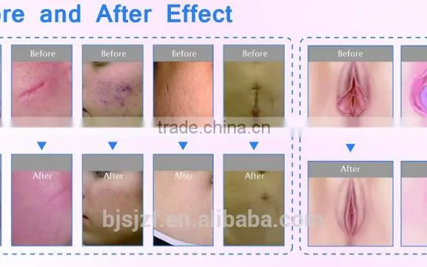 F7+ Co2 Fractional Laser/Vaginal Laser Rejuvenation photo-4