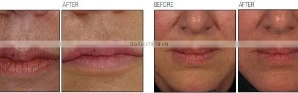 Vaginal Tighten Fractional Co2 Laser RF Tube(HOT in USA) photo-6