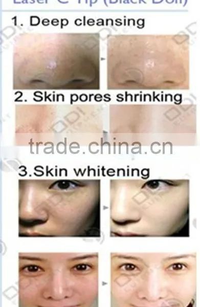 China Factory Best Black Doll Skin Rejuvenationcarbon Powder 50g Acne Treatment Laser Carbon Lotion photo-6