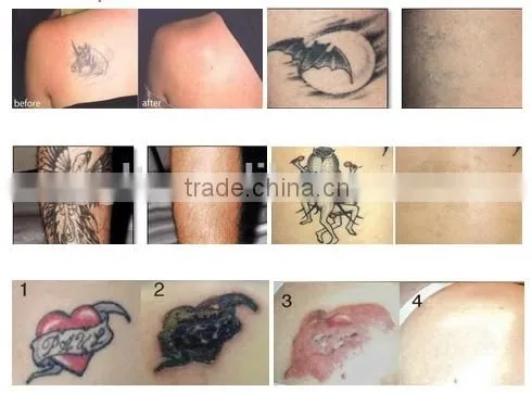 Facial Veins Treatment Tattoo And Freckle Removal Q Switch Mongolian Spots Removal Nd Yag Laser Pigment Removal Beauty Machine photo-2