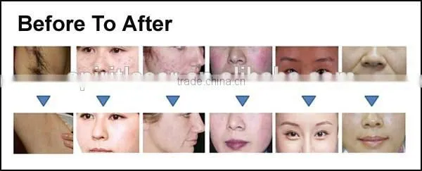 2016 Medical CE Approved Ipl, Ipl Home Laser Pigmentation, Home Ipl photo-4