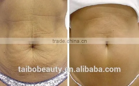 Fractional RF Microneedle Machine For Face Lifting and Skin Tightening ( Bipolar and Monopolar Can Exchanged ) photo-6
