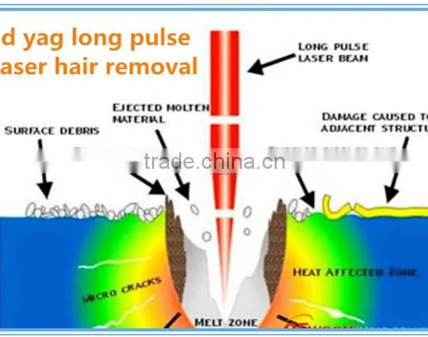 Best Prices Long Quality Warranty 1064nm Long Hori Naevus Removal Pulse Nd Yag Laser Hair Removal Machine Laser Tattoo Removal Equipment photo-6