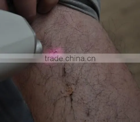 (ISO13485/CE Proof) NEWEST 808nm Hair Laser Removal Machine With Freon Cooling OB-DH 03 photo-5