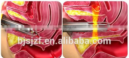 FDA Approved F7+ Vaginal Acne Scar Removal Tightening Machine Fractional Co2 Laser Eliminate Body Odor photo-6