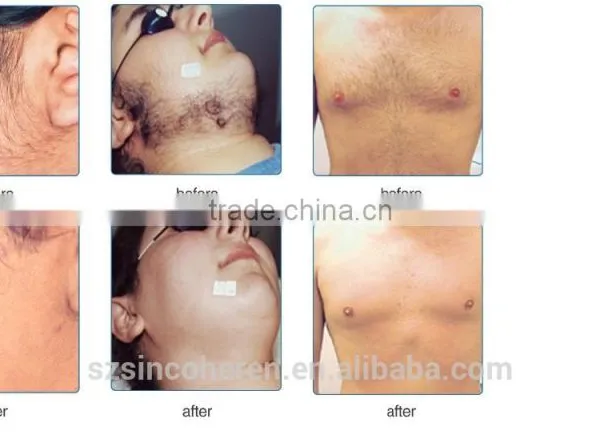 NYC (opt Technology ) Laser Hair Removal and Skin Rejuvenation Machine photo-4