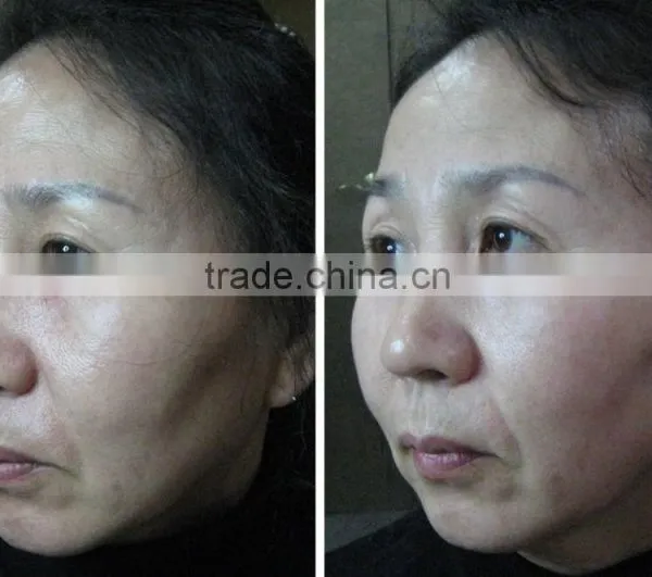 Anti-Puffiness/Skin Tightening/Wrinkle Remover Feature and Anti-Wrinkle Machine Type Lifting HIFU Ultrasound Face Lifting photo-5