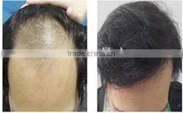 Led and Laser Hair Treatment Hair Regrowth Treatment Machine photo-6