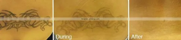 Tattoo Removal Laser Nd Yag Laser photo-6