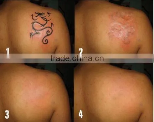 ND YAG Laser7 Joint Arm / Yag Laser 1500mj 7mm Spot Size q Switch 1064nm 532nm Tattoo Removal Machine photo-6