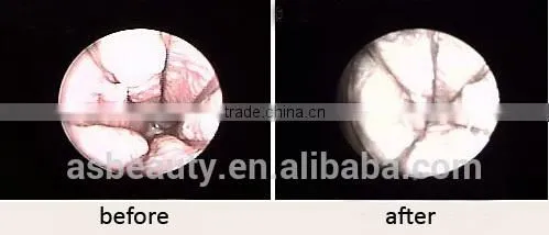 Warts Removal Medical Co2 Fractional Laser Machine/Vaginal 10600nm Carboxytherapy Tightening/ Vaginal Rejuvenation Machine Mole Removal photo-4