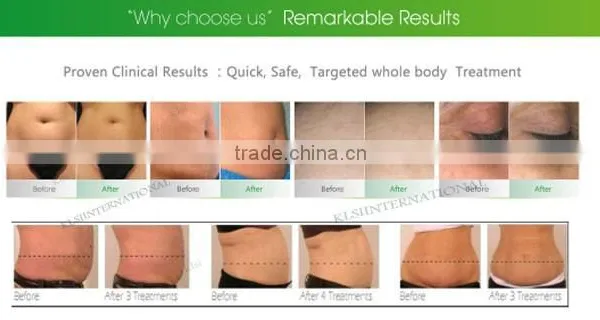 201 5Latest 5 in 1 Vacuum Cavitation RF Body Slimming Machine With Japan Motor photo-4