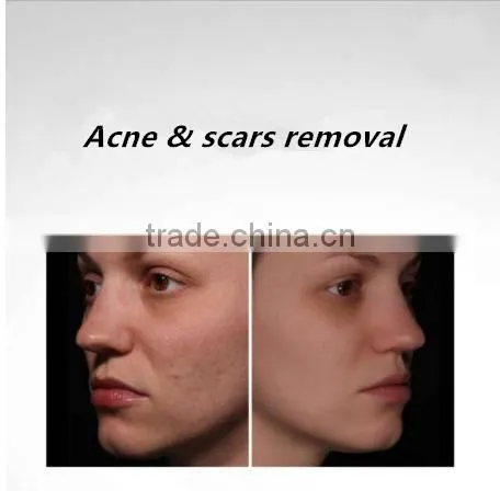3in1 Machine Best Professional Multifunction 755nm Alexandrite Laser and Long Pulsed Laser 1064nm New Laser From Popipl photo-5