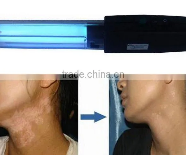 Vitiligo Treatment UV Lamp Curing LAMP