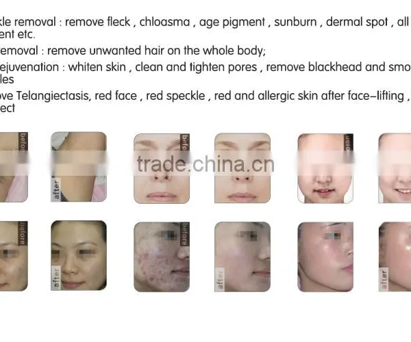 Ipl Shr Hair Removal Machine SHR Vertical Ipl Hair Removal System photo-3