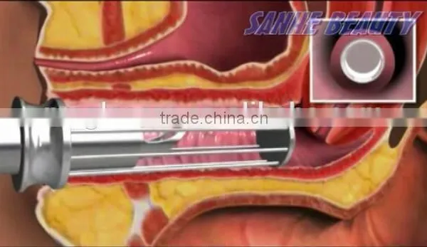 Best Treatment Result for Laser Vaginal Tightening Treatment 40W Fractional Co2 Laser photo-5