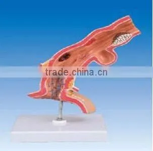 Pathological Model of Esophagus