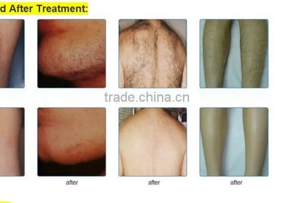 Best View IPL Hair Removal Machine for Skin Care Vascular Removal photo-5