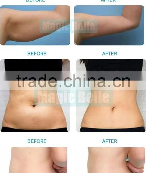 Fat Reduction Portable Cryolipolysis!!! RF/40K Cavitation/Laser Slimming Machine Cryolipolysis Device For Sale Fat Freezing photo-6