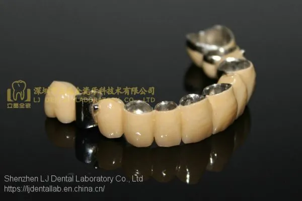 Dental Crown Composite, Dental Teeth, Dental Prosthesis, Laboratoire Dentaire, Dentallabor, Laboratorio Dental, Dental Laboratory, Shenzhen LJ Dental Lab China photo-4