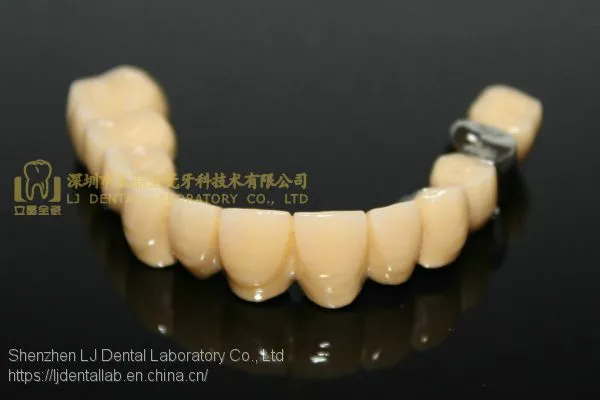 Dental Crown Composite, Dental Teeth, Dental Prosthesis, Laboratoire Dentaire, Dentallabor, Laboratorio Dental, Dental Laboratory, Shenzhen LJ Dental Lab China photo-3