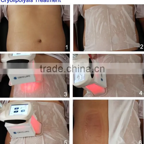 OSANO Cryo Fat Freeze Slimming Machine With 2 Cryo Handles for Sale LM-S600M photo-6