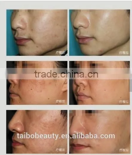 Best rf Monopolar Skin Tightening Face Lifting Machine for Sale photo-6