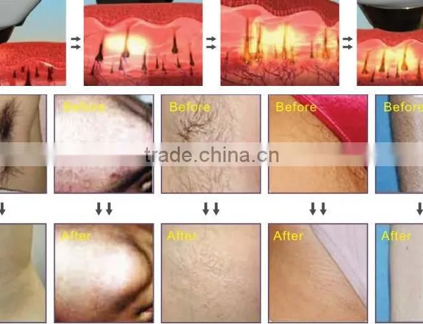 Distributors Wanted Factory Price Diode Laser Hair Loss 808nm Salon photo-2