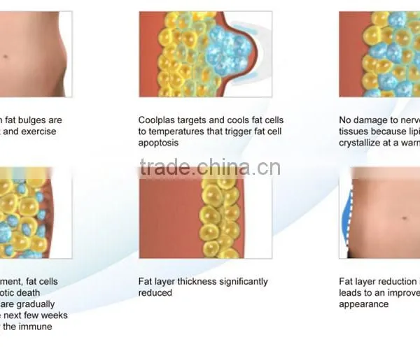 Cryo Machine Fat Freeze Slimming photo-6