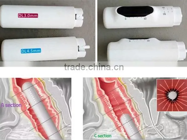High Quality Hifu Vaginal No Pain Tightening Machine For Vagina Rejuvenation Nasolabial Folds Removal photo-3