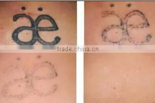 Varicose Veins Treatment Distributors Wanted Tattoo Remover Q Switched 800mj Nd Yag Laser Tattoo Removal Machine/laser Tattoo Removal Machine Price photo-5