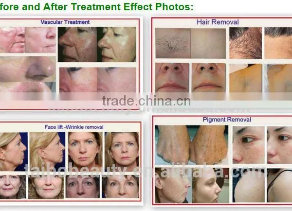 Latest Technology Permanently Remove Hair Machine Delight Facial Hair Remover Laser Facial Rejuvenation photo-6