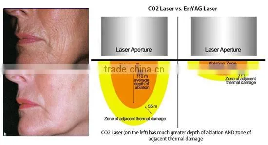 Medical Skin Tightening Fractional Co2 Laser Equipment Skin Treat Telangiectasis Age Spot Removal Rejuvenation Co2 Laser Scar Removal Acne Treatment Face Lifting photo-5