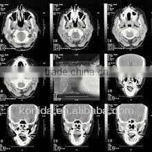 Agfa Digital Film,medical X-ray Image Intensifier,t4 Diagnostic