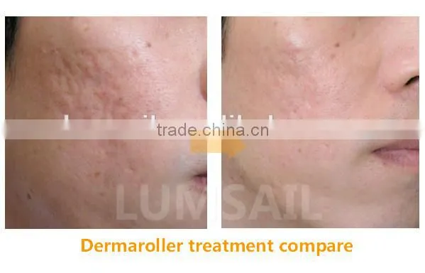 180 192 540 600 Needles Derma Roller Dermaroller Manufacturer photo-4