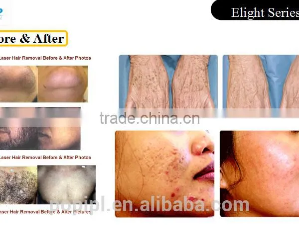 Ipl Laser Hair Removal Equipment IPLlaser Permanent Hair Removal Machine/IPL Laser IPL Laser Hair Removal +Tattoo Removal 3300w photo-4