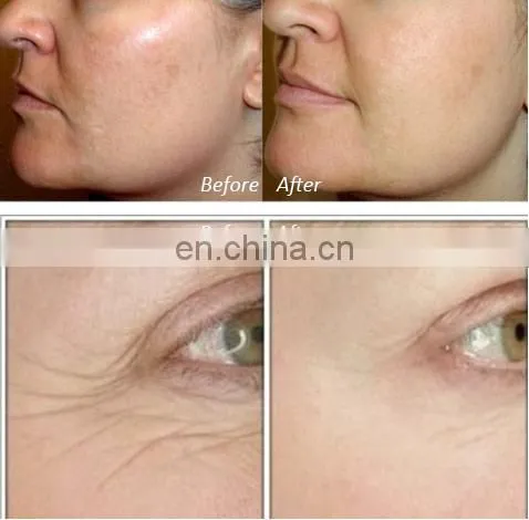 USB Rechargeable Face Lift Skin Tightening Wrinkle Remove RF Beauty Device photo-4